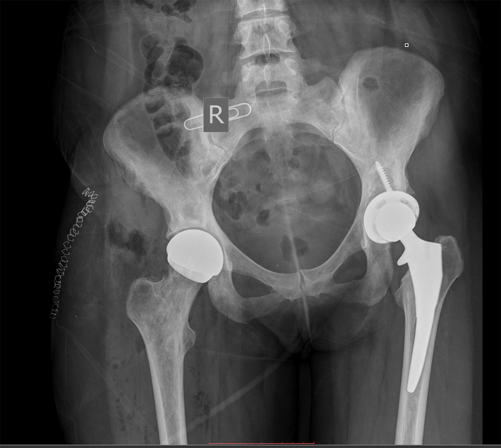 01 hip resurfacing