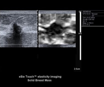 Strain Elastography