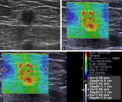 Shear wave Elastography