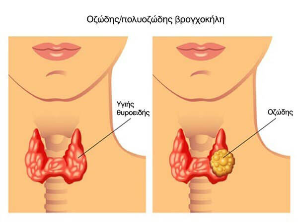 Thiro vroxokili f