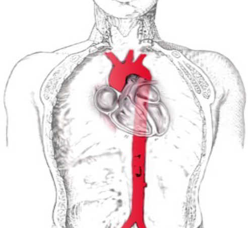 aneurisma aortis gen 1