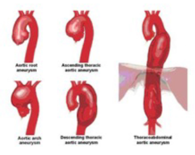 aneurisma aortis gen 2