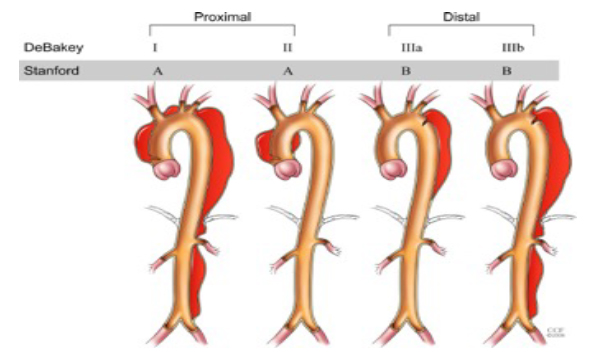 aneurisma aortis gen 3jpg