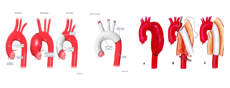 aneurisma aortis gen 5