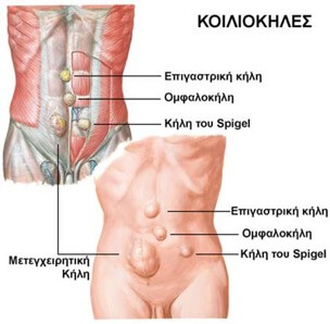 Κοιλιοκήλες