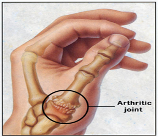 arthritida antixeira inside