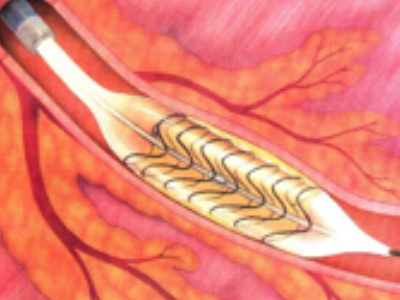 Το stent εκπτύσσεται πλήρως