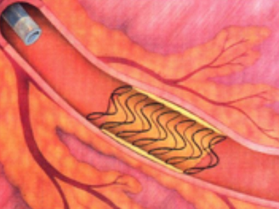 Το stent εκπτυγμένο μέσα στη στεφανιαία αρτηρία