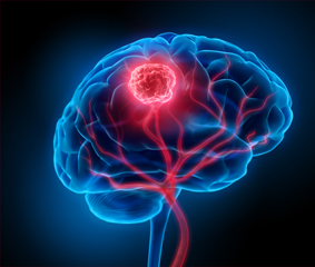 Όγκοι Εγκεφάλου: Τι συμπτώματα προκαλούν και πώς αντιμετωπίζονται;