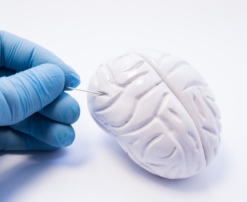 Μηνιγγιώμα εγκεφάλου: Τι είναι πώς αντιμετωπίζεται