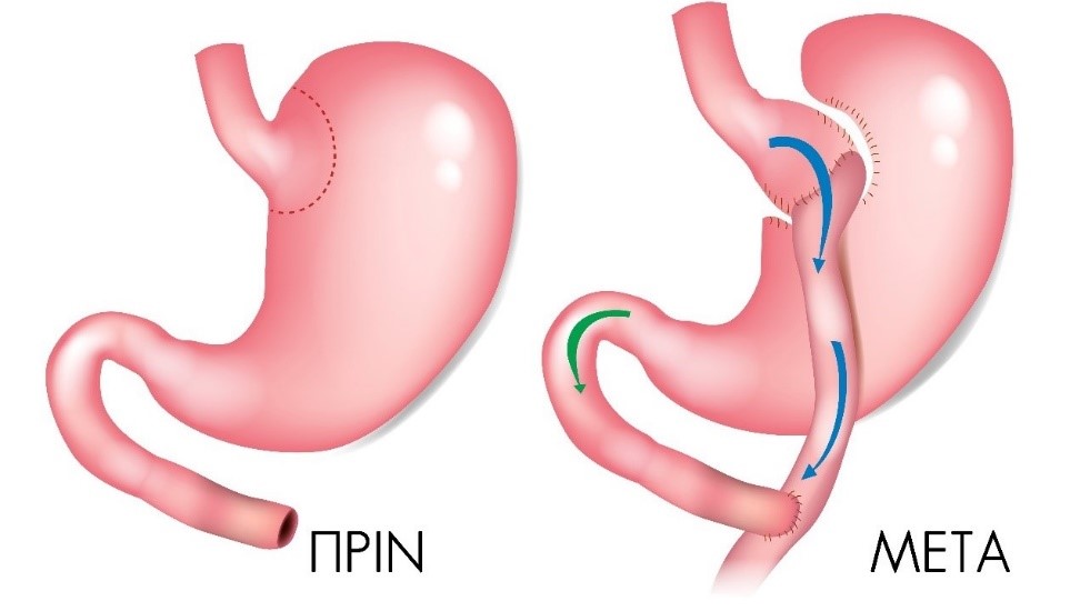Γαστρική Παράκαμψη μίας Αναστόμωσης