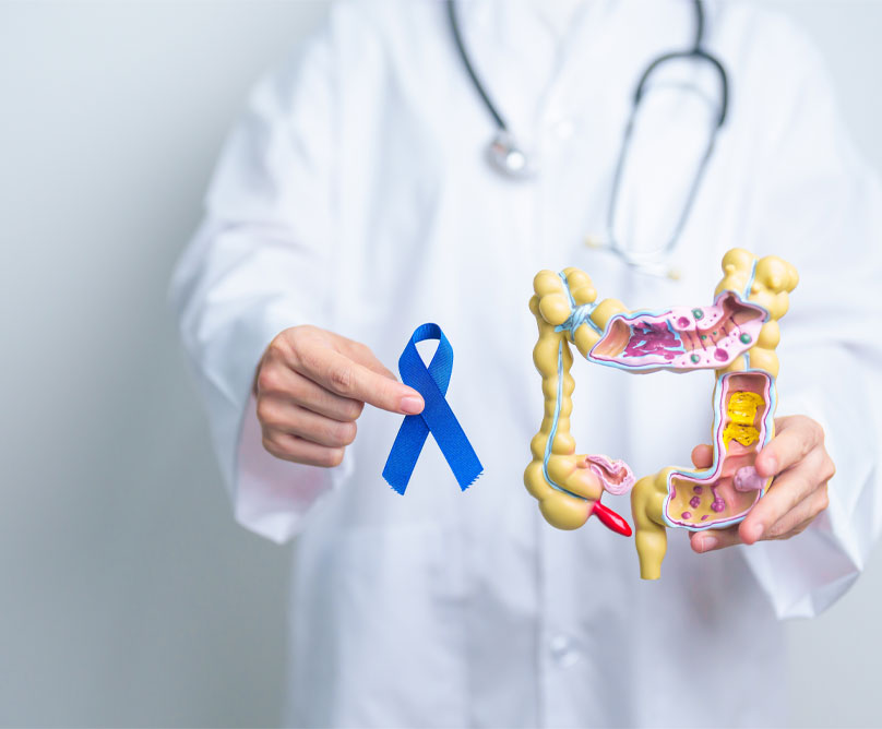 Καρκίνος παχέος εντέρου: Γιατί αυξάνεται στα άτομα κάτω των 50 και πώς προλαμβάνεται