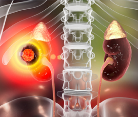 Καρκίνος του νεφρού: ένας σιωπηλός εχθρός