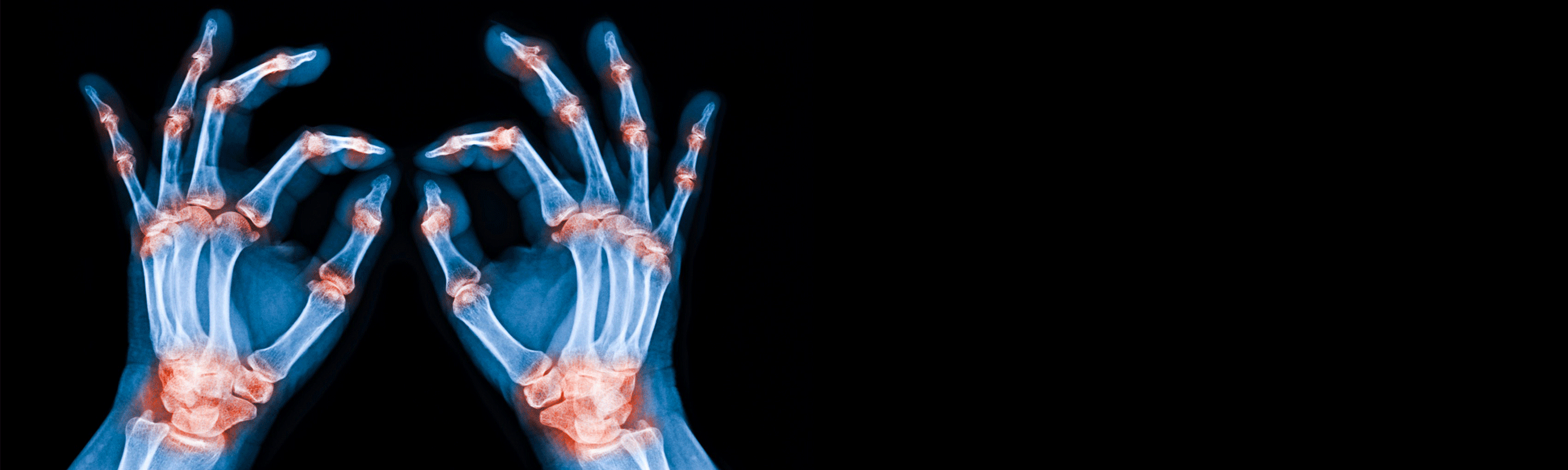 2nd Rheumatology Clinic
