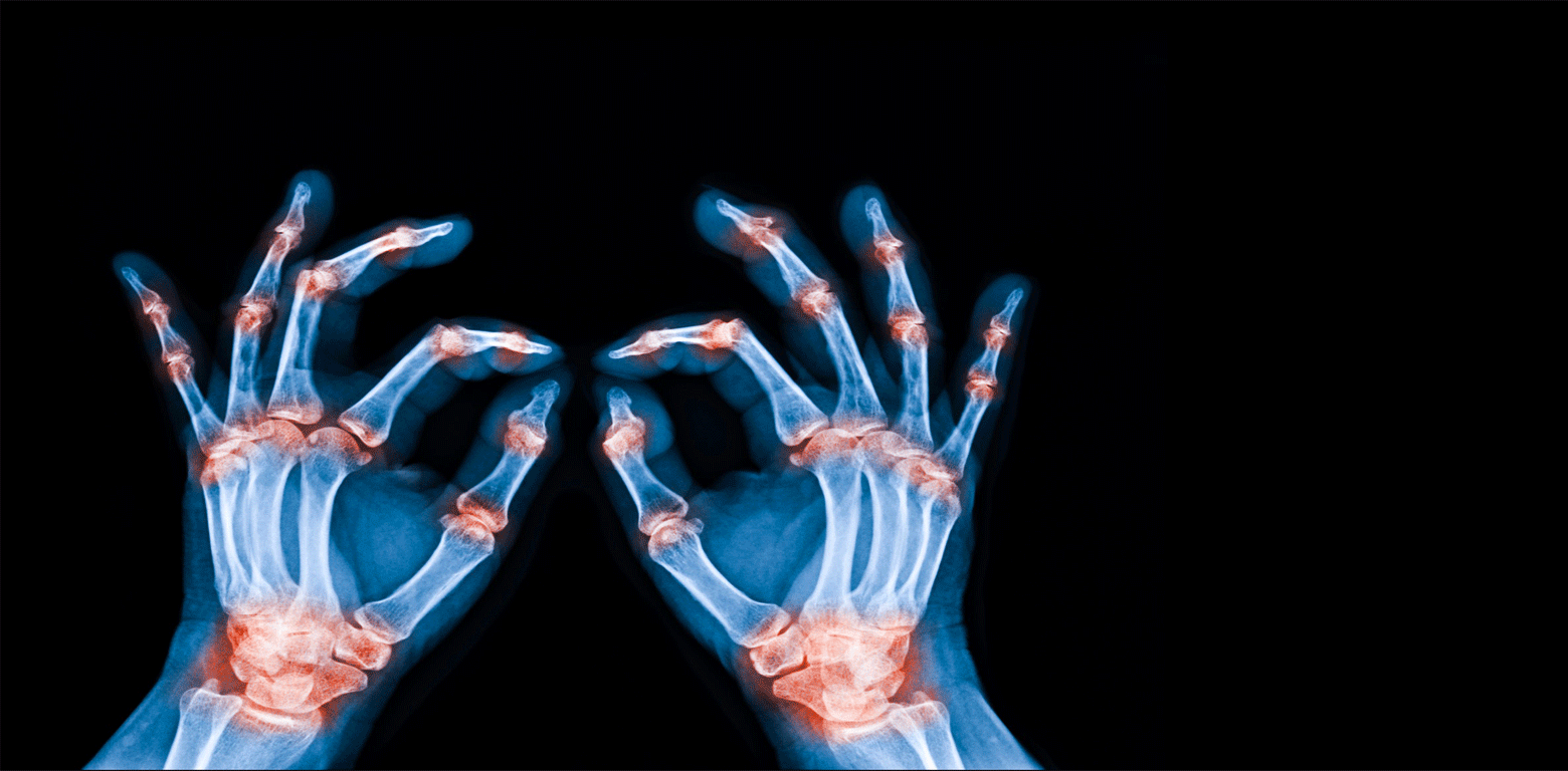 2nd Rheumatology Clinic