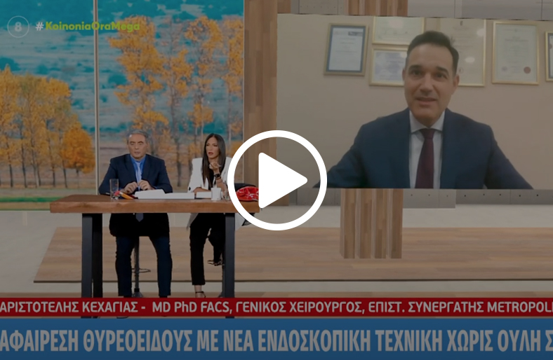 Ενδοσκοπική αφαίρεση θυρεοειδούς χωρίς ουλή | Αριστοτέλης Κεχαγιάς